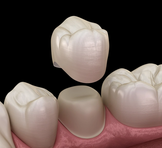 Reliable Protection for Damaged Teeth
