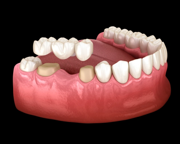 Replace Missing Teeth and Rebuild Your Smile