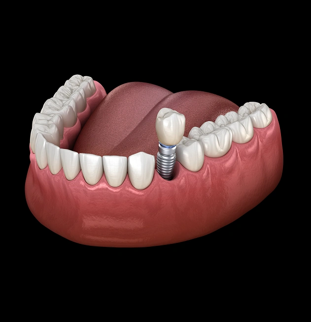 Restore Missing Teeth With Dental Implants