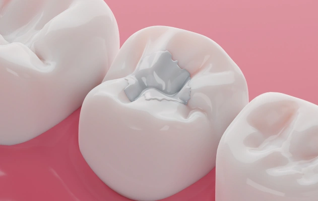 Repair and Protect Your Teeth With Seamless Fillings