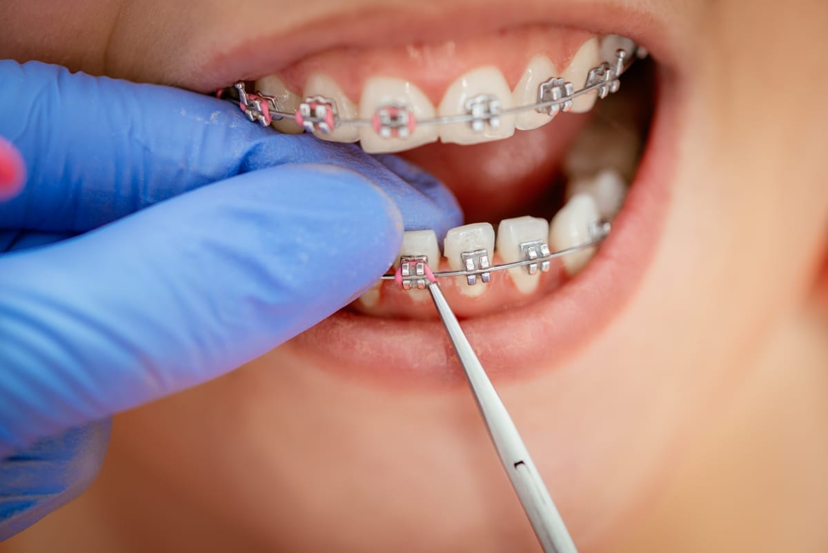 Tooth-Colored Fillings in Richmond