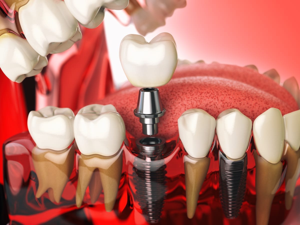 Dental Implants in Richmond